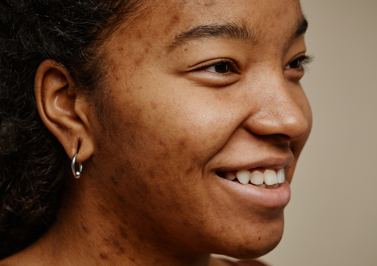Hyperpigmentation
